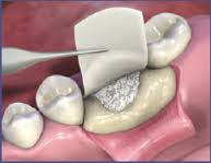 Oral Cavity Repair Membrane Market