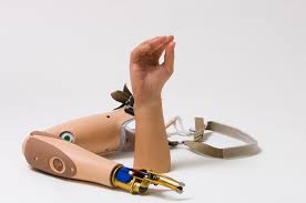 Myoelectric Hand Prosthesis Market