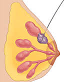 Global Breast Biopsy Localization Wire Market