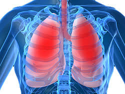 Idiopathic Pulmonary Fibrosis