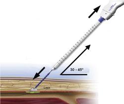 Large Bore Vascular Closure Devices