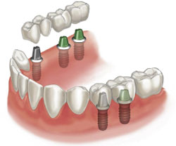 Dental Bridges