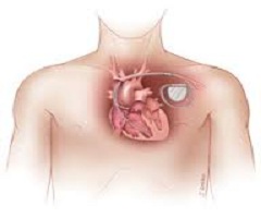 Implantable Cardiac Pacemaker